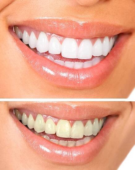 Cosmetic-Bleaching-web