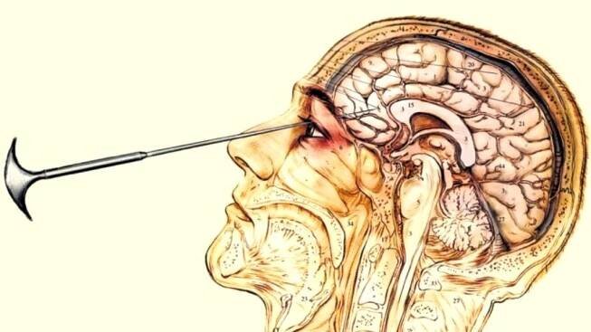 Lobotomy (Slang)
