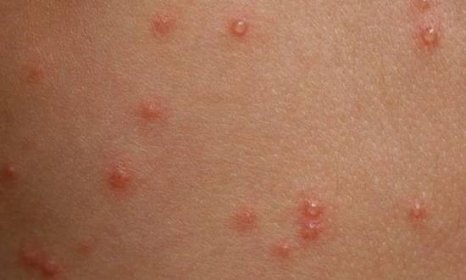 Plané neštovice u dospělých - Jak dlouho se léčí?
