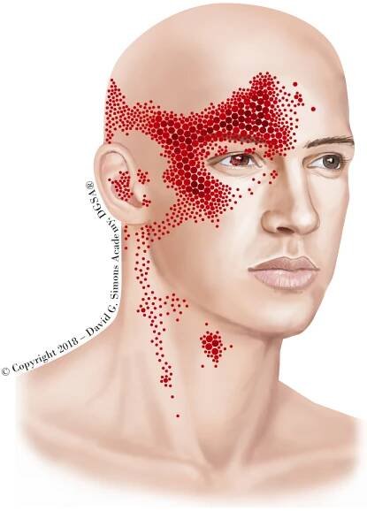 Referred Pain Pattern des M. sternocleidomastoideus
