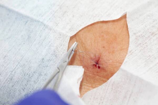 dermatolog provádějící kožní biopsii na obličeji staršího dospělého pacienta. lékař šije pacienta během malé operace. - zlatý stafylokok - stock snímky, obrázky a fotky
