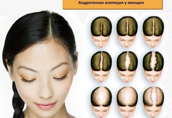 Ženská hormonální alopécia androgenní alopecie / Články