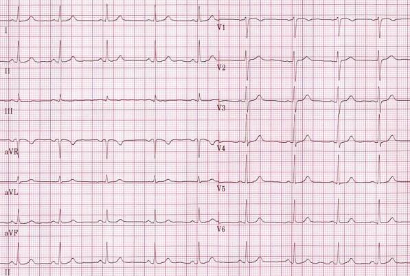 ECG sinus rhythm, regular rhythm 75bpm, normal P waves, narrow QRS, constant PQ PR interval