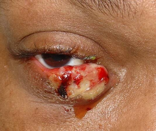 herpes-simplex-ocni-vicko
