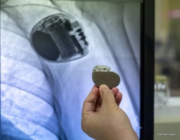 doctor hand držet pacemaker zařízení s obrazovkou rentgenového obrazu trvalé implantace kardiostimulátoru - kardiostimulátor - stock snímky, obrázky a fotky