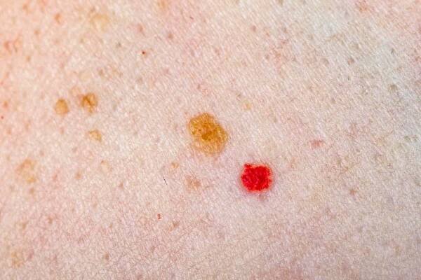 Névus a cherry angioma na lidské kůži — Stock obrázek