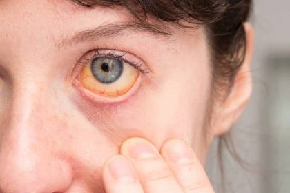 Příznaky, které bychom neměli podceňovat: zežloutnutí kůže a očního bělma.