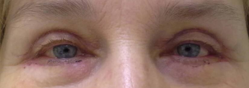 Blefaroplastika - víčka | OB CARE Centrum plastické chirurgie