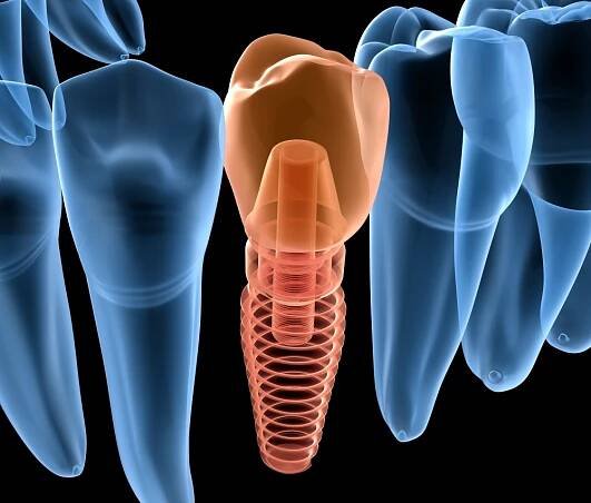 What are Dental Implants