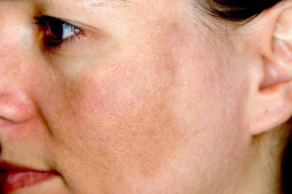 Your Guide to Melasma: How To Treat Tricky Dark Spots - The Pretty Pimple