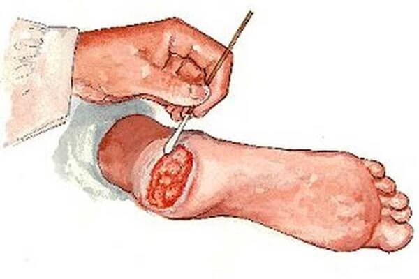 Gangréna nohou u diabetes / Gangréna | Užitečné informace a tipy na péči o sebe. Zdraví, výživa a další.