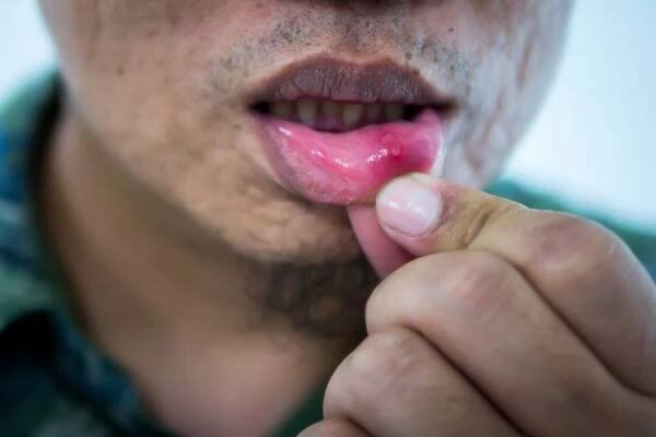 Man's lip with herpes lesion