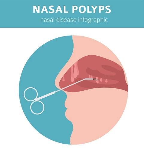 Nosní onemocnění. Příčina, diagnostika a ošetření nosní polypy — Ilustrace