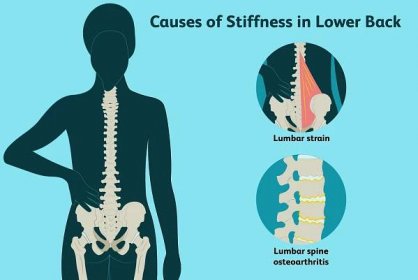 Causes of Stiffness in Lower Back - Illustration by Alexandra Gordon