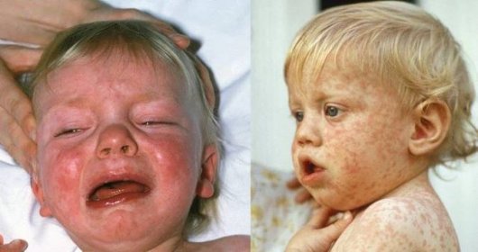 Spalničky se šíří Českem i kvůli rodičům, kteří své děti odmítají nechat očkovat (ilustrační foto).