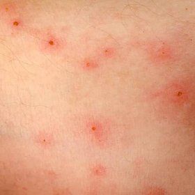 Nemocný alergická vyrážka dermatitida ekzémy kůže pacienta — Stock obrázek