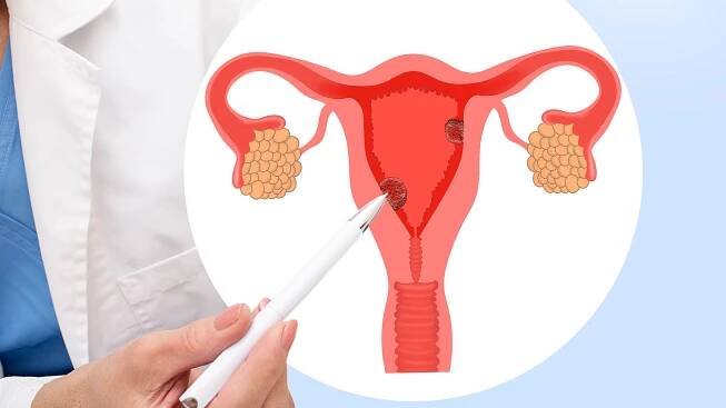 Rakovina – karcinom – dělohy – endometria