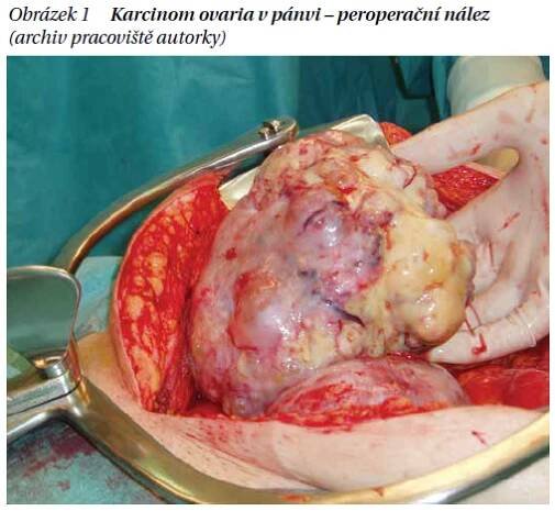 Léčba ovariálního karcinomu - PROFI Medicína