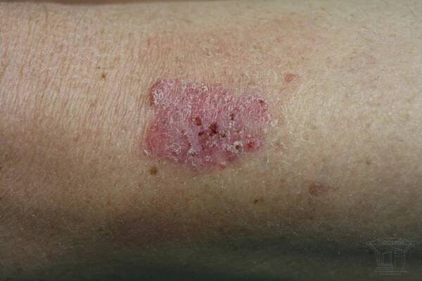 Fotografie kožních chorob | Česká Akademie dermatovenerologie