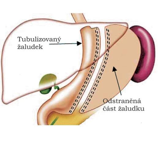 Tubulizace žaludku