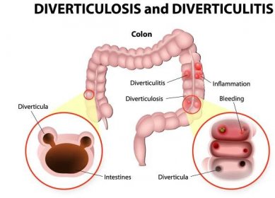 Conditions - Diverticulosis - Dr. Markides