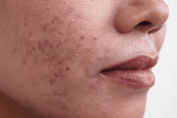 Odstranění jizev a flíčků po akné – SKIN HEALTH kosmetika Praha