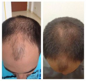 Hair loss treatment ResurHair • aetherclinic