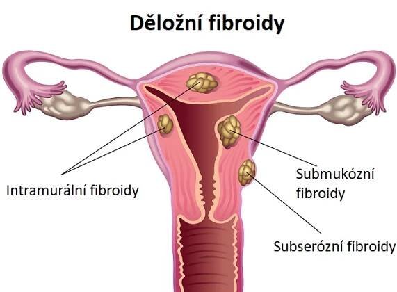 Děložní fibroidy (myomy) - ilustrace