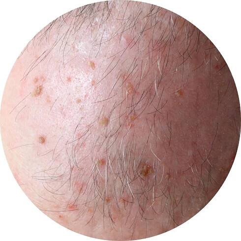 actinic keratoses