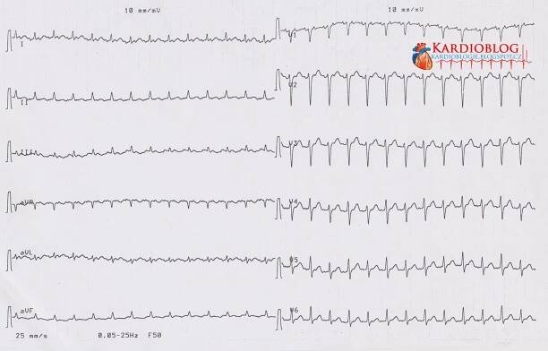(EKG Kazuistika) Flutter síní 2:1 - Kardioblog