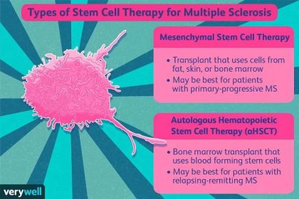 Stem Cell Treatment for Multiple Sclerosis