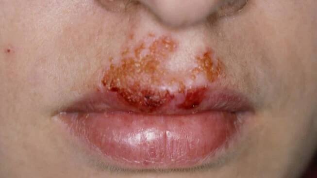 Infekce impetigo