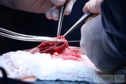 Operace nádoru tlustého střeva | iDobryDen 