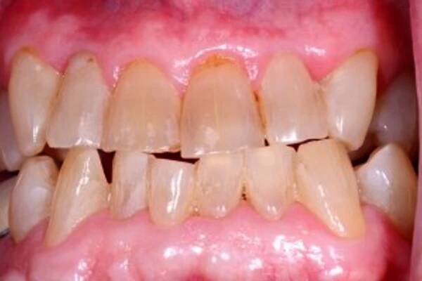Seeing is Believing - Amazing KöR Whitening Results