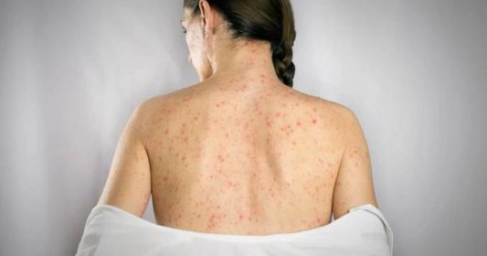 mujer con herpes zoster