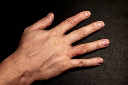 Dermatitida rukou. Finger ekzém — Stock obrázek