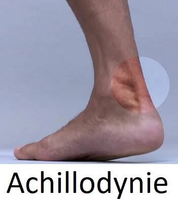Achillodynie (syndrom Achillovy šlachy) – co je to – příznaky, příčiny a léčba