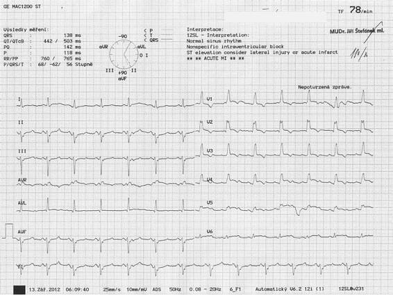 EKG z praxe 21 | Medicína, nemoci, studium na 1. LF UK