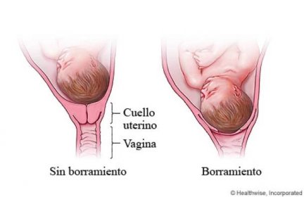 ¿Qué es el borrado del cuello uterino?