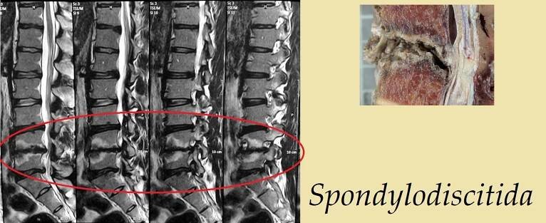 spondylodiscitida-zanet-patere-priznaky-projevy-symptomy