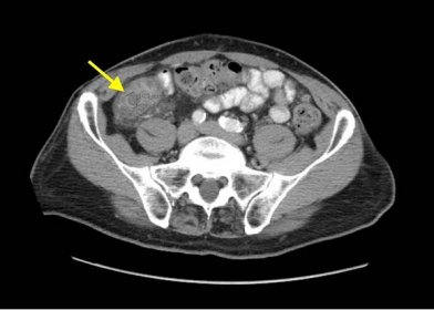 Imaging Findings of Small Bowel - Diverticulitis: A Case Report 13