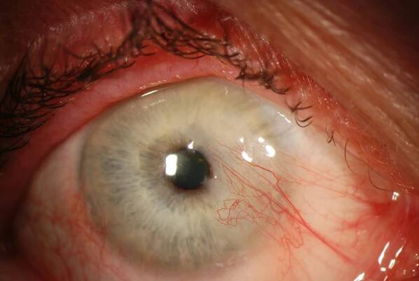 Dacryoadenoma - EyeWiki