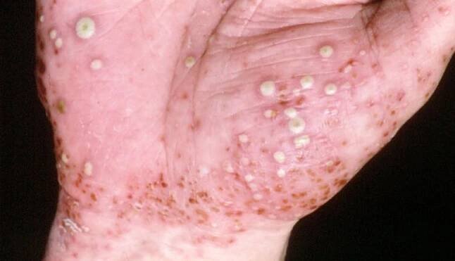 Pustular psoriasis on white skin.