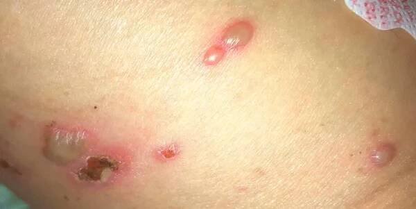 Herpes zoster contagious, uncrusted vesicles on skin — Stock obrázek