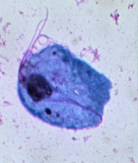Trichomoniasis