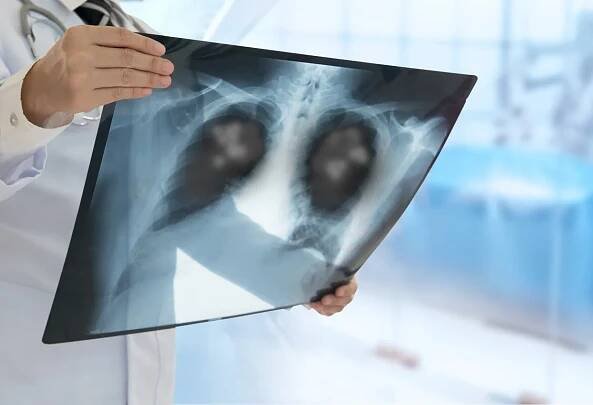 Nejúčinnější léčba plic, o které jste pravděpodobně nikdy neslyšeli – INFOKURÝR
