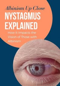 Nystagmus Explained: How it Impacts the Vision of Those with Albinism