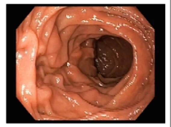 horní gastrointestinální endoskopie. jícnový gastický polyp. - big toe - stock snímky, obrázky a fotky