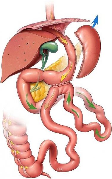 Single anastomosis sleeve ileal bypass a single anastomosis sleeve jejunal bypass v chirurgické léčbě těžké obezity | Rozhledy