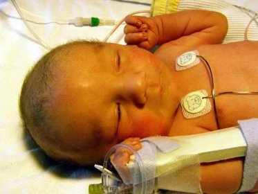 Infant with jaundice in neonatal intensive care unit